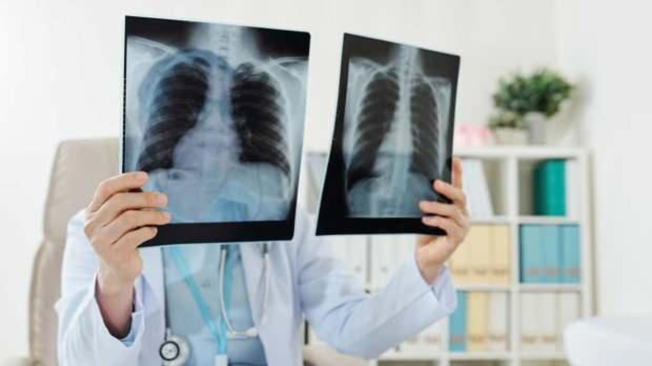 Akciğer zarı kanseri mezotelyoma nedir? Mezotelyoma yaşam süresi…