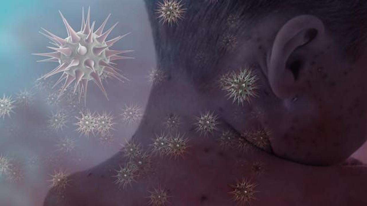 Nijerya’da kızamık salgını: 19 çocuk öldü