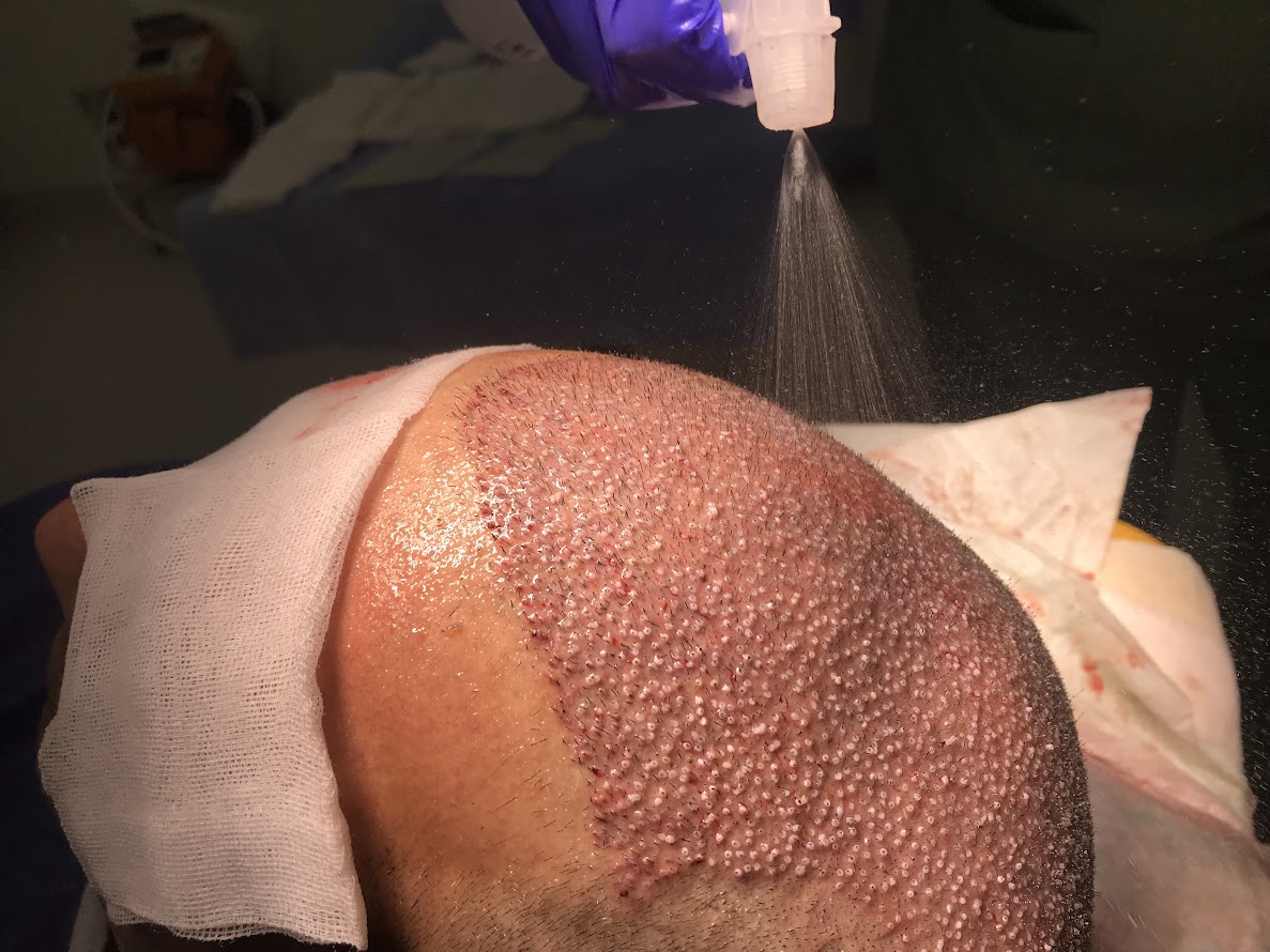 Clinista Saç Ekim Merkezi: Saç Ekimi Alanında Uzmanlaşmış Merkezi