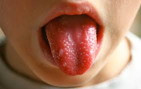 Kawasaki Hastalığı Nedir?