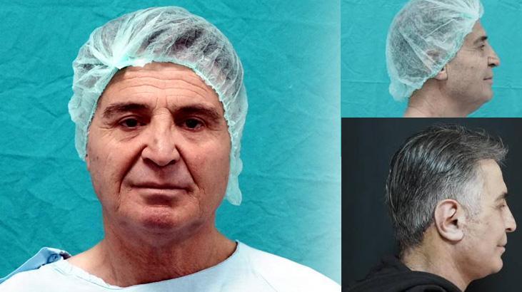 Bitlis Devlet Hastanesi’nde İlk Derin Plan Yüz Germe Ameliyatı Yapıldı